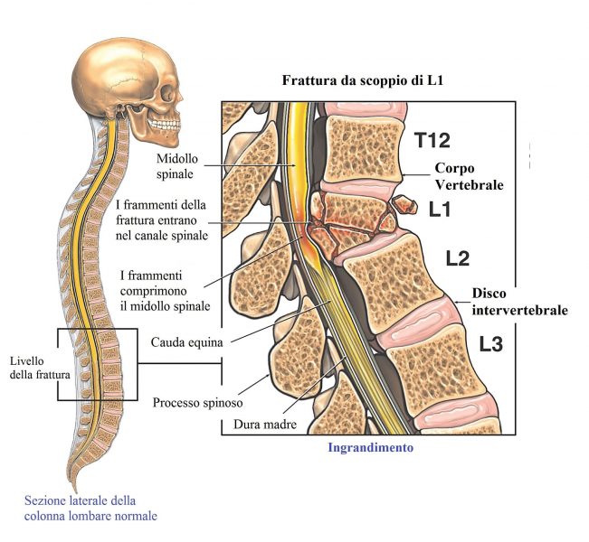 Frattura della vertebra lombare L1 da scoppio