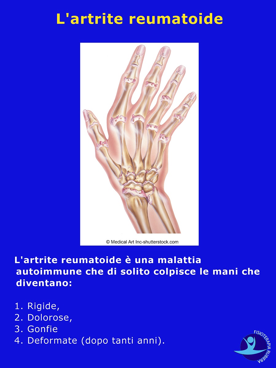 L'artrite reumatoide