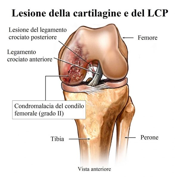 Lesione del legamento crociato posteriore,condromalacia,ginocchio