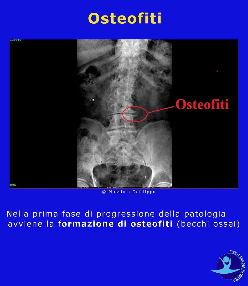 Osteofiti