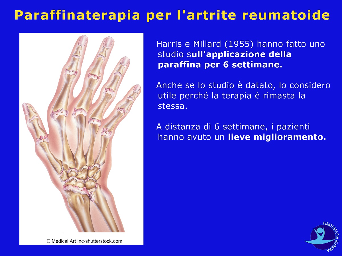 Paraffinaterapia per l'artrite reumatoide