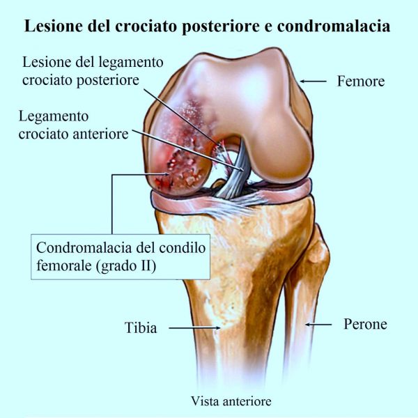 Rottura del crociato posteriore,cartilagine,ginocchio