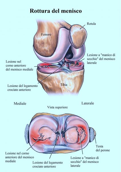 Rottura del menisco,mediale,laterale,interno,esterno