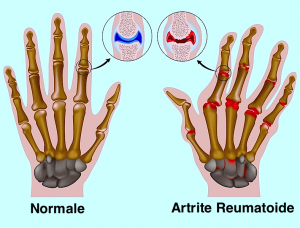 Sintomi dell'artrite