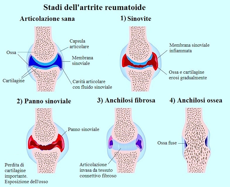 Sintomi dell’artrite Reumatoide