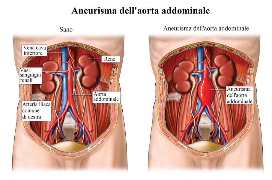 Aneurisma,aorta addominale,arteria