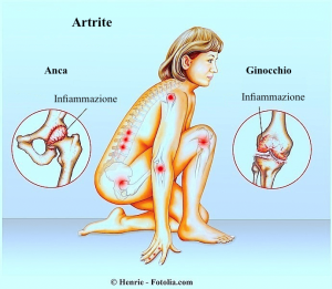 articolazioni,infiammazione,diverse,multiple,dolore,male,limitazione,funzionale,artrite