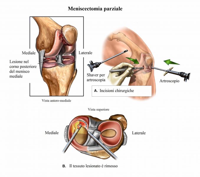 Artroscopia di ginocchio,menisco,meniscectomia,mediale