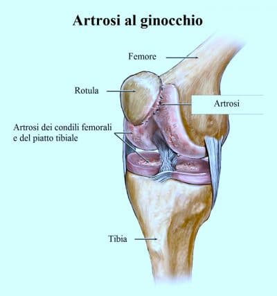 Artrosi al ginocchio,cartilagine