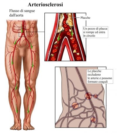 aterosclerosi,trombosi venosa profonda,placche nelle arterie