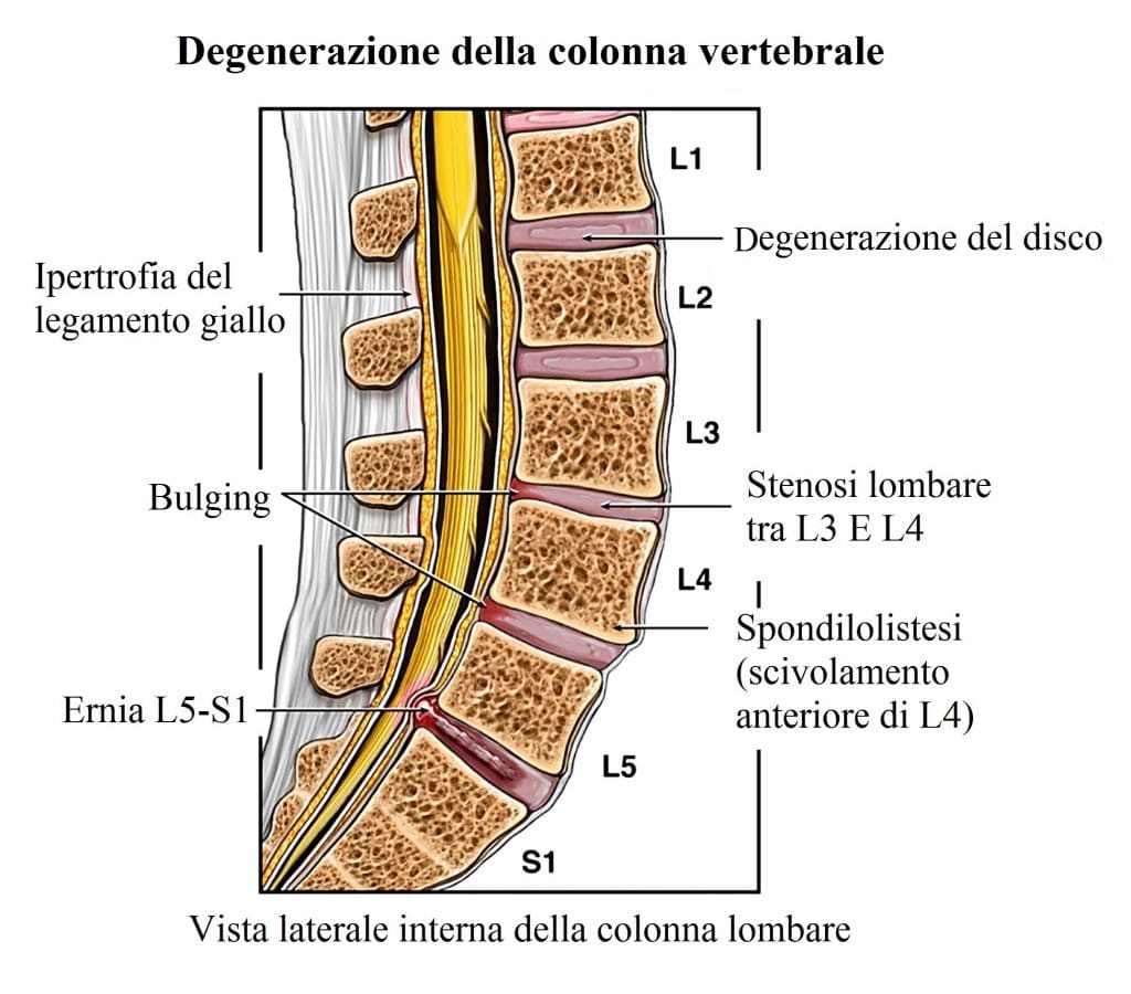 Artrosi vertebrale,bulging,ernia,spondilolistesi,degenerazione