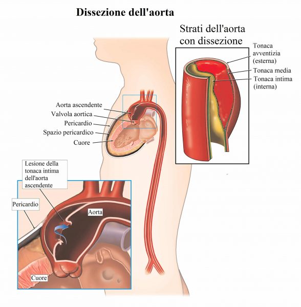 Dissezione aortica,aorta,arteria