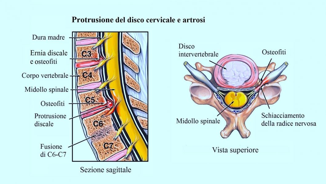 Ernia discale,osteofiti,artrosi