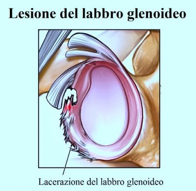 Lesione del labbro glenoideo