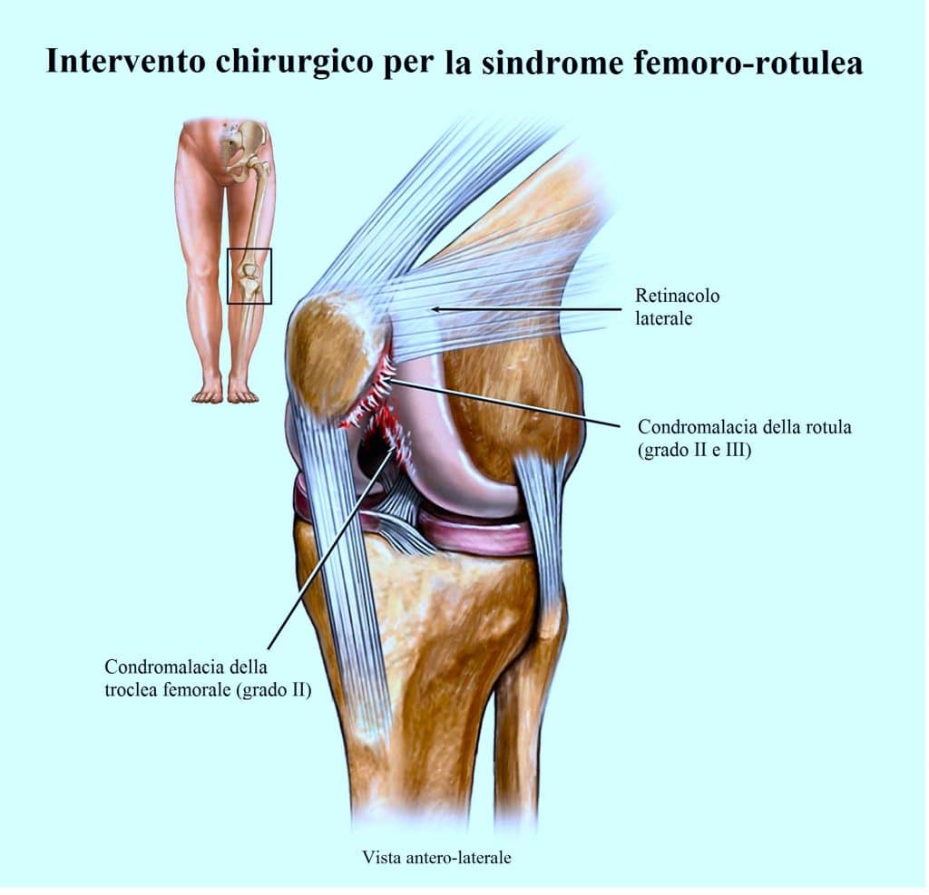 lesione della cartlagine del ginocchio,sindrome femoro rotulea