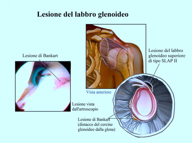 Lesione del labbro glenoideo,bankart,slap