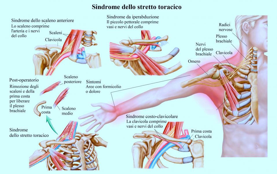 Sindrome dello stretto toracico,dolore al braccio