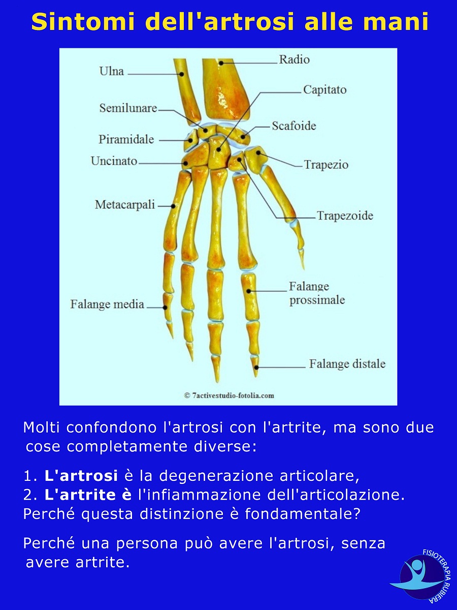 sintomi dell'artrosi alle mani