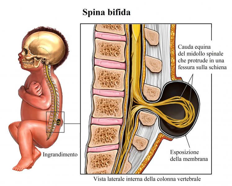 spina bifida,incontinenza urinaria