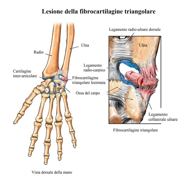 Fibrocartilagine triangolare,legamento collaterale ulnare,lesione,rottura