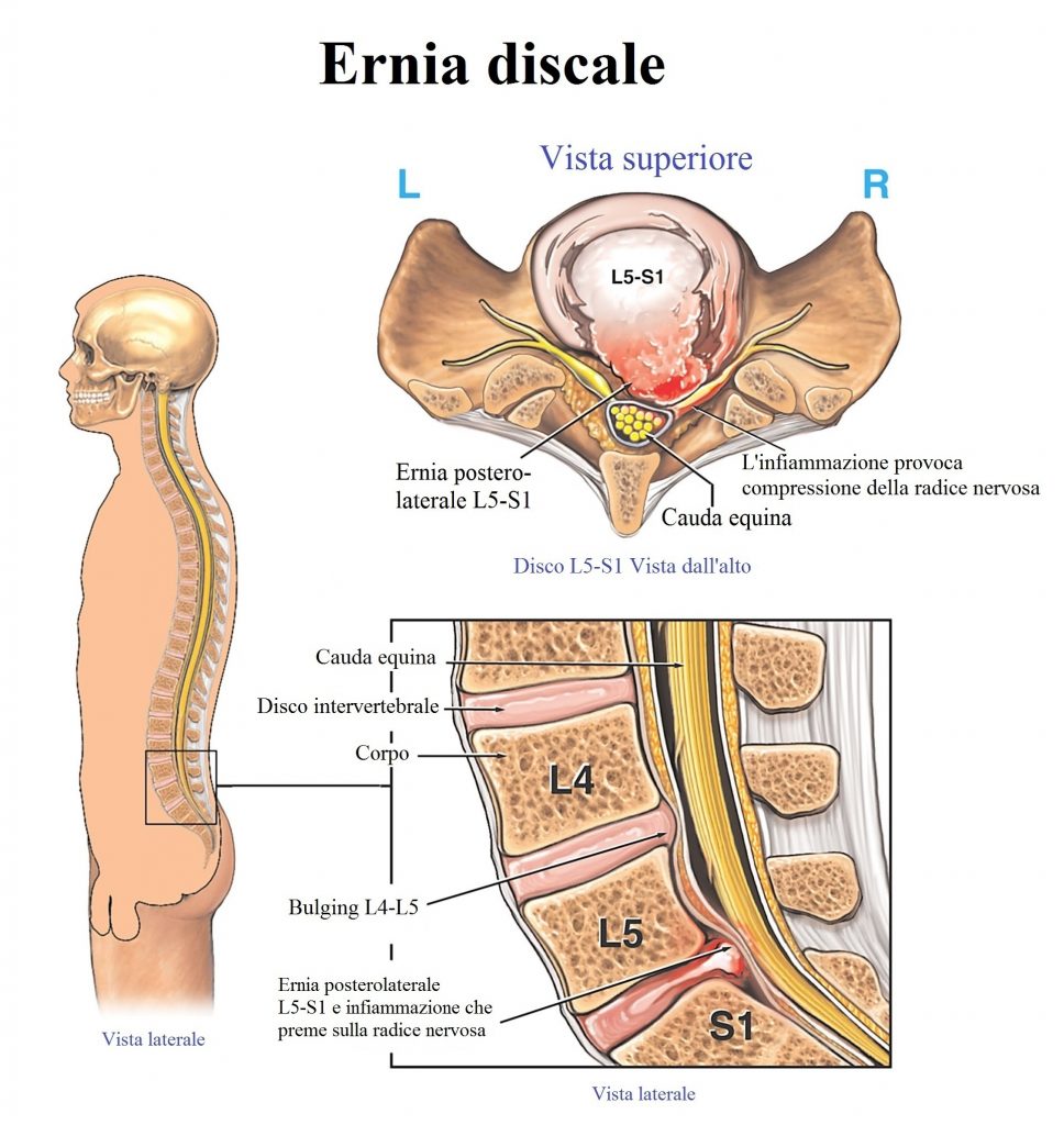 Ernia del disco lombare